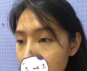 总以为眼综合是双眼皮+开眼角，面诊了苏州康美才知道00后的自己更适合切开重睑+上睑下垂矫正
