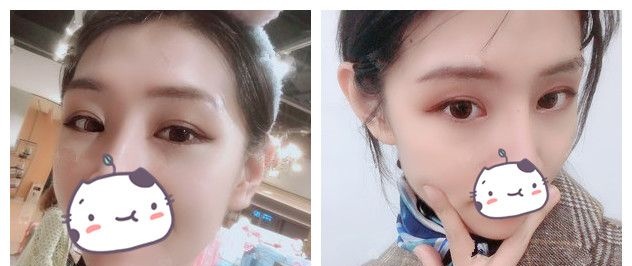 总以为眼综合是双眼皮+开眼角,面诊了苏州康美才知道00后的自己更适合切开重睑+上睑下垂矫正 图2