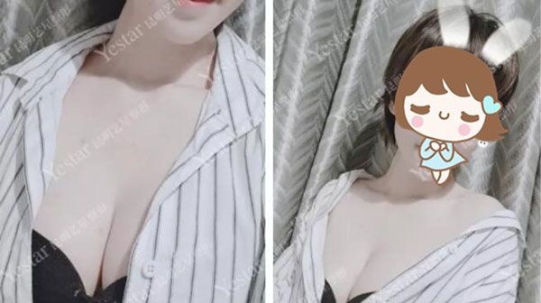 谈谈我在昆明艺星找徐威做麦格假体丰胸295CC真实感受及术后恢复效果 案例图2