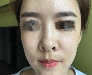 经过一次玻尿酸隆鼻失败后我选择李春雷医生做硅胶隆鼻手术进行修复 还为大家带来唐山苏亚美联臣鼻部整形价格表
