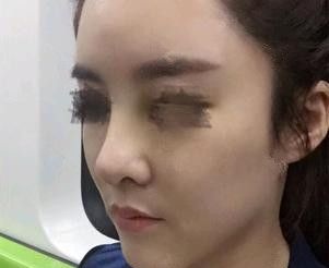 经过一次玻尿酸隆鼻失败后我选择李春雷医生做硅胶隆鼻手术进行修复 还为大家带来唐山苏亚美联臣鼻部整形价格表 图2