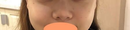 丑了25年的蒜头鼻,找景德镇圣嘉丽刘志强做了膨体+肋软骨隆鼻综合术竟如同换了一张脸