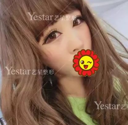 我就是嘉兴艺星整形张占召做bsk宫廷鼻综合隆鼻手术的一枚鲜活案例,现分享60天恢复日记