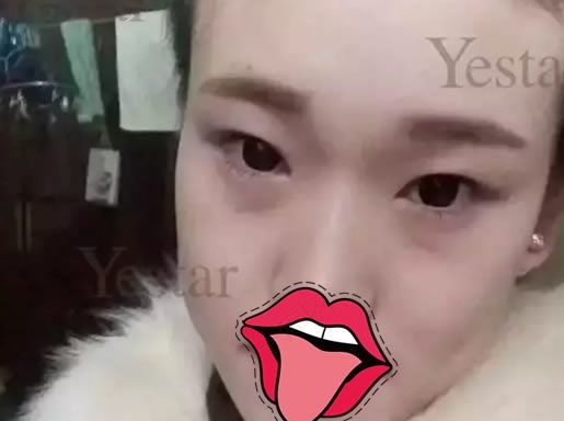贴了两年的双眼皮贴后到嘉兴yestar艺兴整形找储刚主任做了双眼皮开眼角手术和玻尿酸填充太阳穴