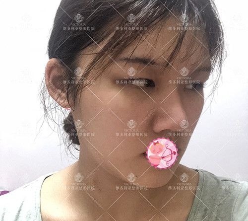 听别人说做完眼综合都丑了 可当我看到张家口维多利亚眼部整形案例还是选择孙凯医生做了切开双眼皮和开眼角手术效果如我预想那样