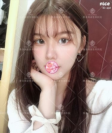 听别人说做完眼综合都丑了 可当我看到张家口维多利亚眼部整形案例还是选择孙凯医生做了切开双眼皮和开眼角手术效果如我预想那样 图2