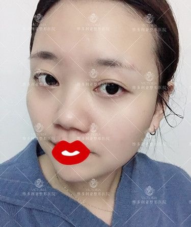天生大脸在张家口维多利亚做自体脂肪填充后使我拥有精致立体上镜脸 面部没有变大且很假的症状