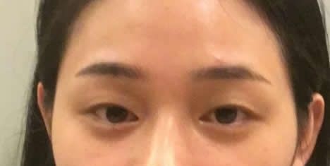 咨询预约杭州艺星整形杨连华做了双眼皮和开眼角后,我知道为什么艺兴做双眼皮价格比较贵啦!