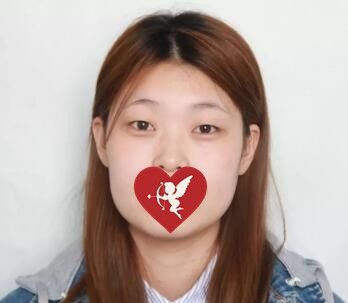 讲述我找辽宁曙光整形外科做埋线双眼皮+开眼角综合手术过程及术后30天恢复效果图!