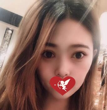 讲述我找辽宁曙光整形外科做埋线双眼皮+开眼角综合手术过程及术后30天恢复效果图! 图2