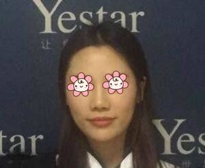 伊婉C玻尿酸怎么样？在长沙艺星整形注射伊婉C玻尿酸丰额头术后37天效果图分享