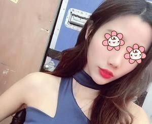 伊婉C玻尿酸怎么样?在长沙艺星整形注射伊婉C玻尿酸丰额头术后37天效果图分享 图2