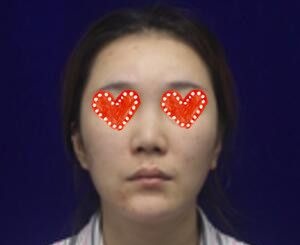 湖南常德德美整形医院怎么样?看我找符恒做硅胶假体+耳软骨综合隆鼻术后40天恢复效果图就知道了!