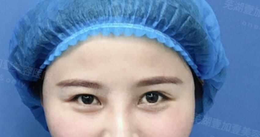 在芜湖壹加壹做全切平行双眼皮+开内眼角眼综合是为了修复我埋线后失败的双眼皮 附上1-15天恢复过程图