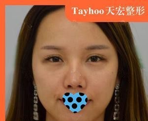 担心硅胶隆鼻后遗症出现的人来看我在石家庄天宏做艳冠硅胶假体隆鼻手术效果怎么样