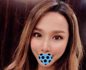 担心硅胶隆鼻后遗症出现的人来看我在石家庄天宏做艳冠硅胶假体隆鼻手术效果怎么样 图2
