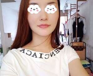 找长沙星雅医疗美容李雯做自体脂肪填充全脸术后50天效果图分享 图2