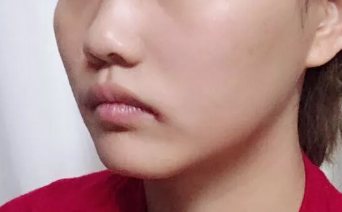 菏泽华美做假体隆鼻手术挺好的,并且菏泽华美做隆鼻的价格也不贵