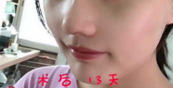 菏泽华美做假体隆鼻手术挺好的,并且菏泽华美做隆鼻的价格也不贵 图2