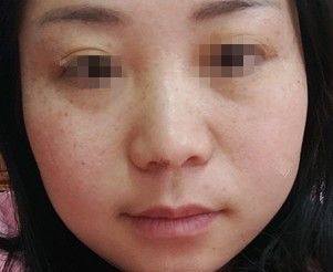 后悔没早点到泰州丽都做激光祛雀斑,刚做完有些微红一个月斑点就淡化了没有反弹结痂留疤什么辅作用