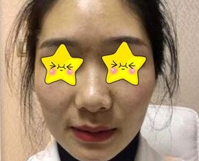 自体脂肪填充面部后脸会不会显得很胖？用我找长沙脸博士医疗美容唐永丰做全脸脂肪填充术后40天效果图告诉你答案！