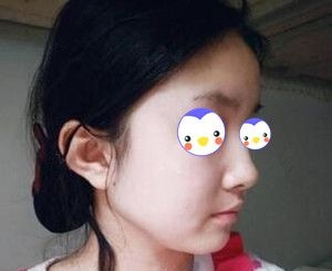 沈阳元辰医美是正规的吗?看了我找谭臻田院长做自体脂肪填充面部术后40天效果图就知道了!