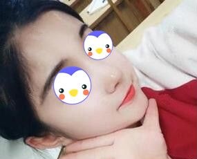 沈阳元辰医美是正规的吗?看了我找谭臻田院长做自体脂肪填充面部术后40天效果图就知道了! 图2
