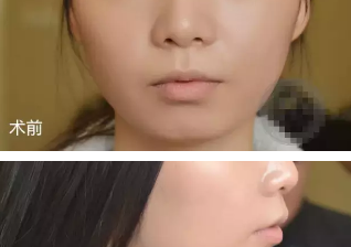 看吧！淄博大学生去烟台做了玻尿酸垫下巴手术，虽说过程波折但是结局很满意