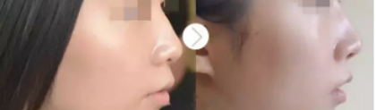 看吧!淄博大学生去烟台做了玻尿酸垫下巴手术,虽说过程波折但是结局很满意 图2