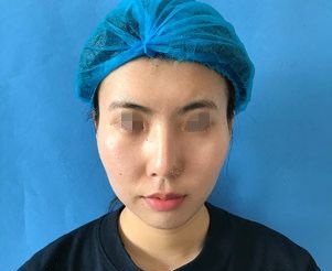 泰州做自体脂肪填充多少钱?看过丽都的价格后我去填充了60ml纯脂肪目前术后恢复一周了