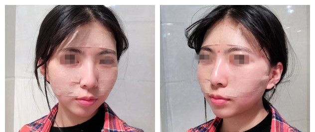 泰州做自体脂肪填充多少钱?看过丽都的价格后我去填充了60ml纯脂肪目前术后恢复一周了 图2
