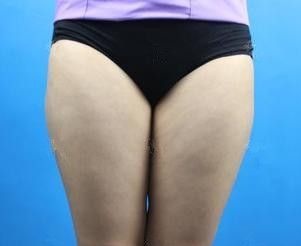 想要瘦成小鸟腿的妹纸可以参考我在石家庄天伊美做大腿抽脂后14天的图片