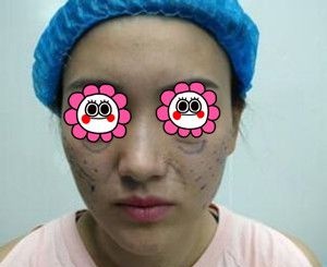 找长沙脸博士医疗美容唐永丰给我做完面部埋线提升+玻尿酸填充40天后让我拥有元气少女脸!