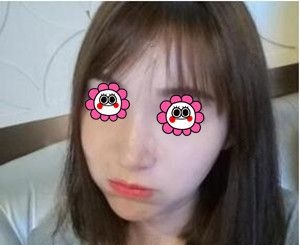 找长沙脸博士医疗美容唐永丰给我做完面部埋线提升+玻尿酸填充40天后让我拥有元气少女脸! 图2