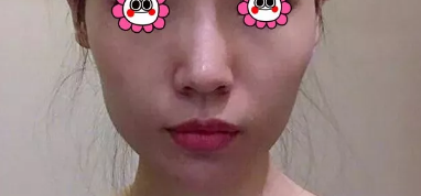 日照医疗美容医院做自体脂肪填充手术挺厉害的,不信的话请看我的日记