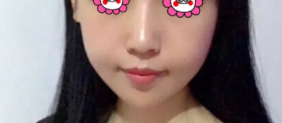 日照医疗美容医院做自体脂肪填充手术挺厉害的,不信的话请看我的日记 图2