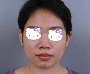 做完鼻综合后对颜值提升有多大？看我找海南华美郭文煜做肋软骨鼻综合+假体垫下巴术后30天恢复效果图就知道了！