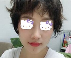 做完鼻综合后对颜值提升有多大?看我找海南华美郭文煜做肋软骨鼻综合+假体垫下巴术后30天恢复效果图就知道了! 图2