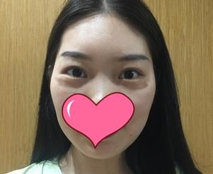 终于把30岁显老的“罪魁祸首眼袋”到武汉艺星用内切法取出了,术后48天效果感觉还不错