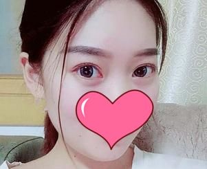 终于把30岁显老的“罪魁祸首眼袋”到武汉艺星用内切法取出了，术后48天效果感觉还不错 案例图2