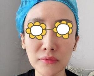 面部下垂的我找大连爱德丽格医疗美容冯勇做完埋线提升30天后终于又重现年轻态!