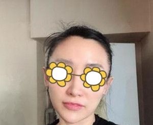 面部下垂的我找大连爱德丽格医疗美容冯勇做完埋线提升30天后终于又重现年轻态! 图2
