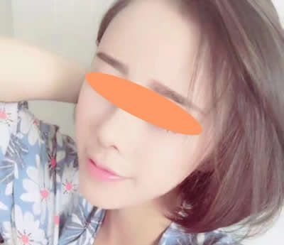 西宁时光王双余主任给我做的假体隆鼻+自体软骨鼻基底填充收到好多朋友称赞 图2