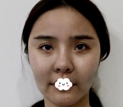 说说我花一万多元找东莞壹加壹朱建生做面部线雕埋线提升的亲身经历和感受
