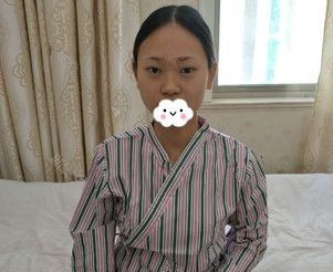 泰州丽都整形内部员工分享硅胶+自体耳软骨隆鼻+翘睫美瞳双眼皮术后一年蜕变照片