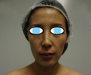 如果想去南阳做自体脂肪面部填充可以参考我这份案例对比照