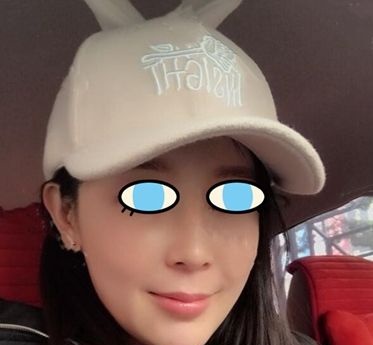 如果想去南阳做自体脂肪面部填充可以参考我这份案例对比照 图2