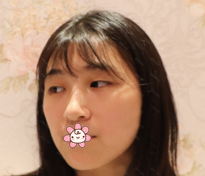 看朋友找佛山华美梁宗建院长做的双眼皮效果那么自然我也忍不住去做了眼综合