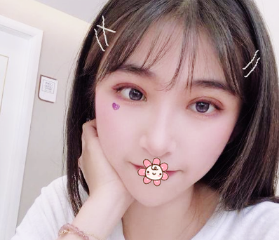 看朋友找佛山华美梁宗建院长做的双眼皮效果那么自然我也忍不住去做了眼综合 图2