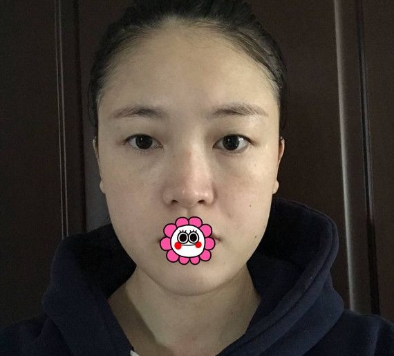 听说温科磊坐诊杭州薇琳而且他做的双眼皮自然灵动是真的吗?